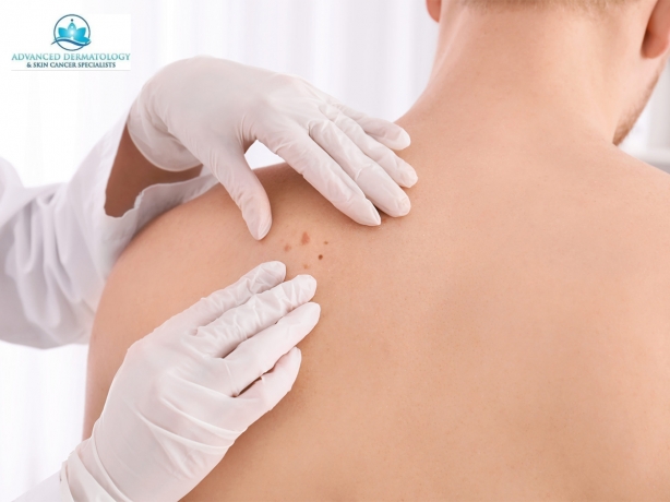 Caught Too Late? The Risks of Delayed Skin Cancer Diagnosis